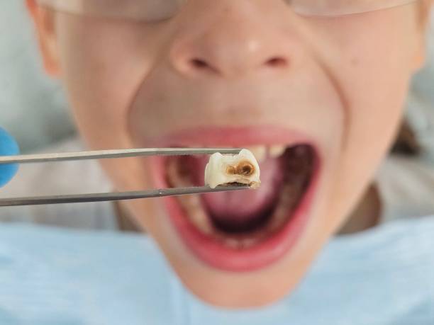 Best Emergency Broken Tooth Repair in De Soto, KS